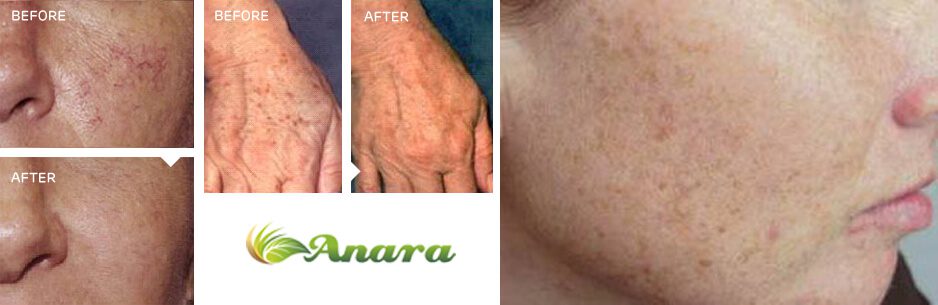 Brown spots age spots uneven skin tone rosacea Anara Medspa