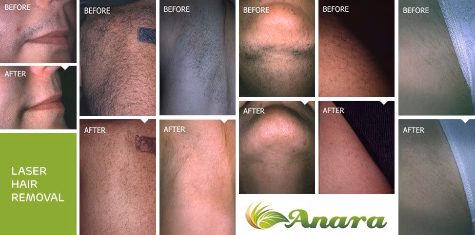 Permanent Laser Hair Reduction in New Jersey