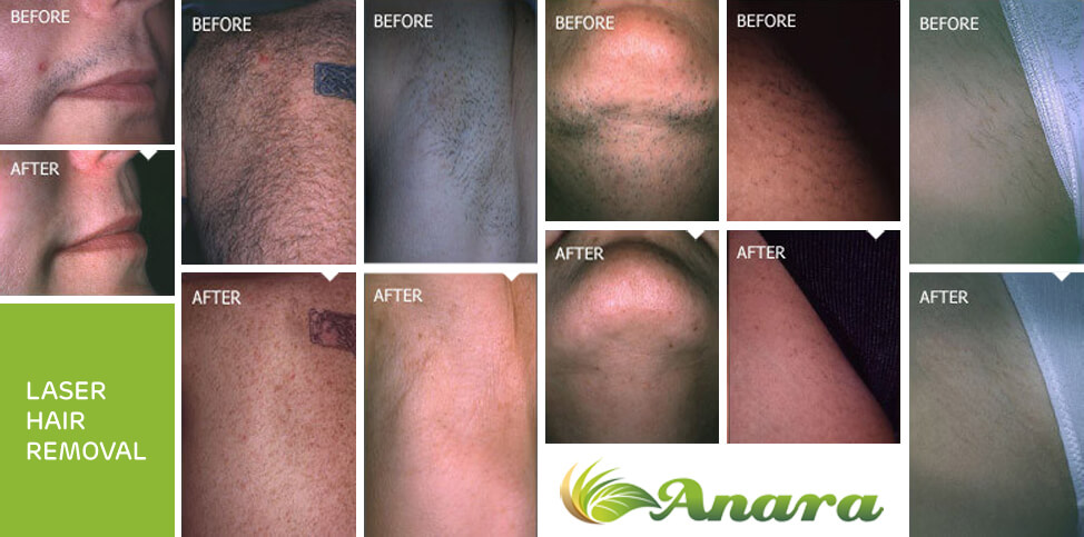 Laser Hair Removal In New Jersey | Anaramedspa in New Jersey