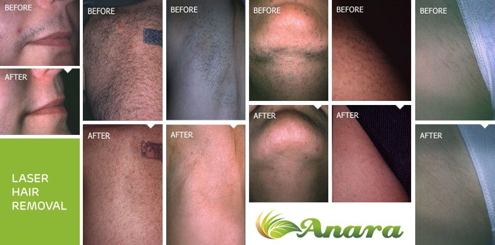 laser hair removal nj