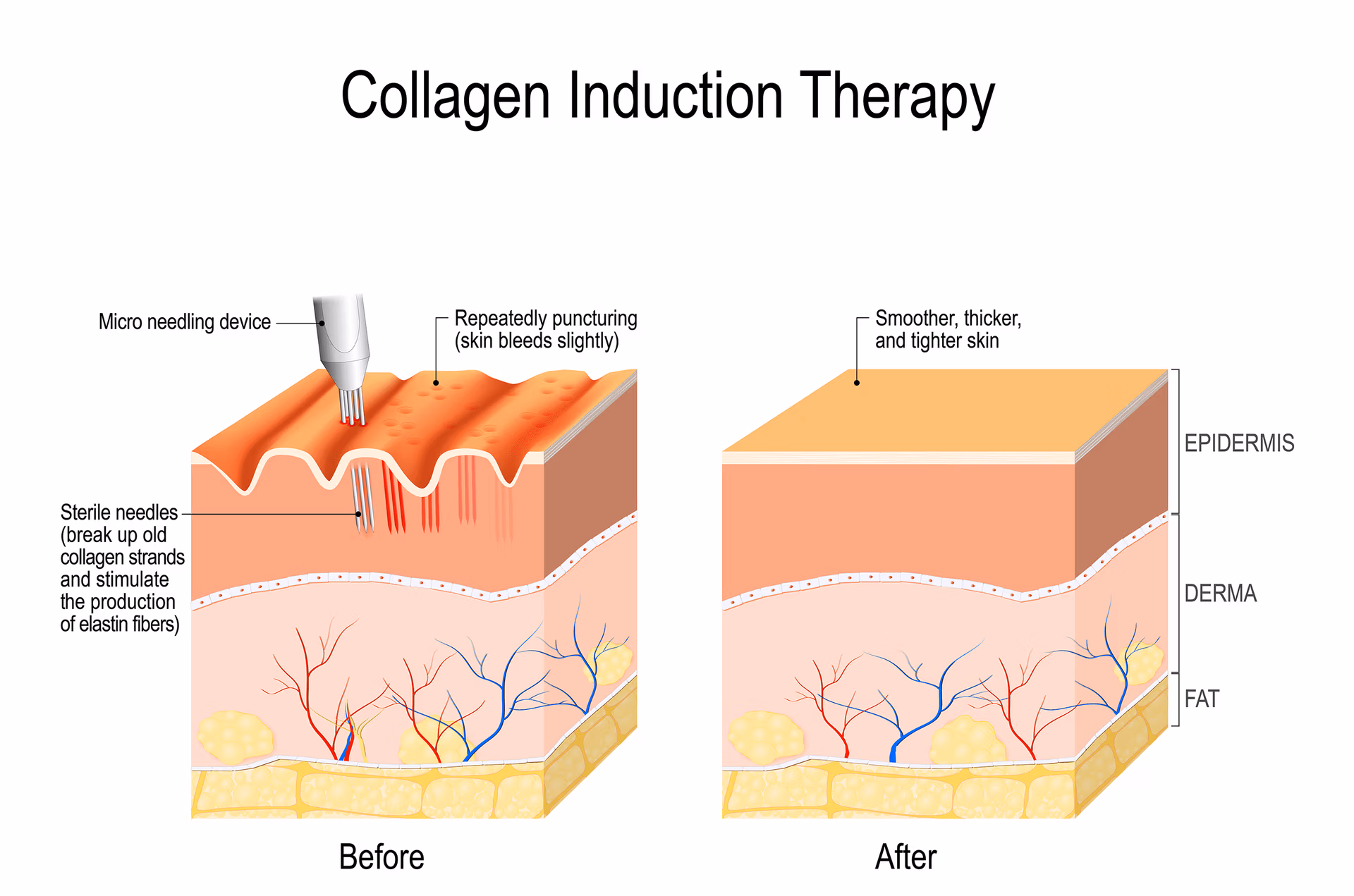 Microneedling