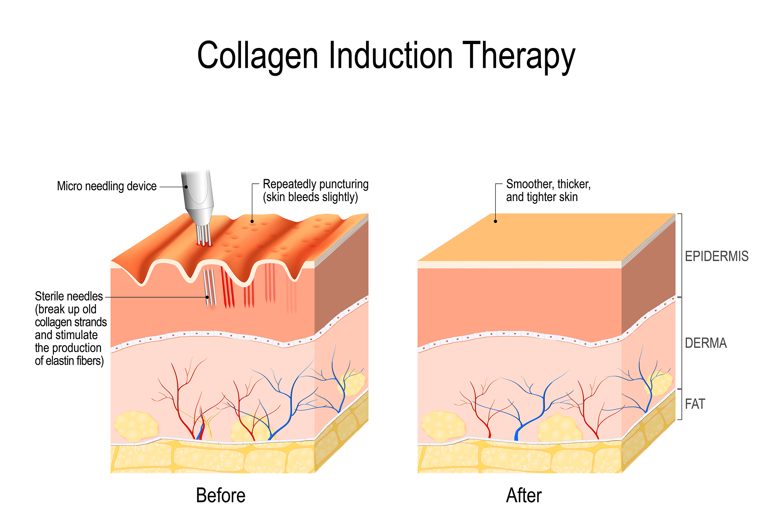Microneedling