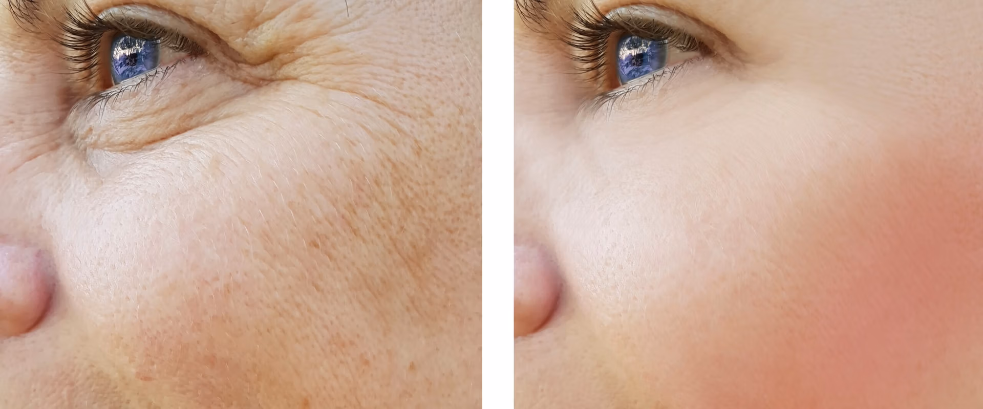 IPL Photofacial laser treatment in New Jersey