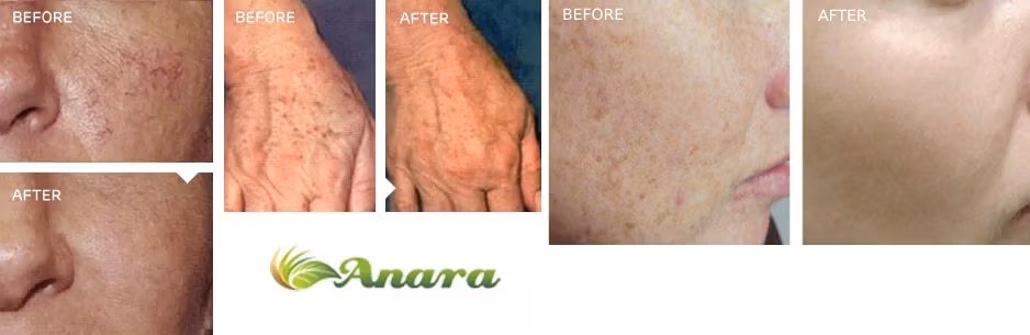 IPL Laser Treatment for Brown Spots, Uneven Skin & Rosacea in New Jersey IPL Laser Treatment for Brown Spots, Uneven Skin & Rosacea in New Jersey