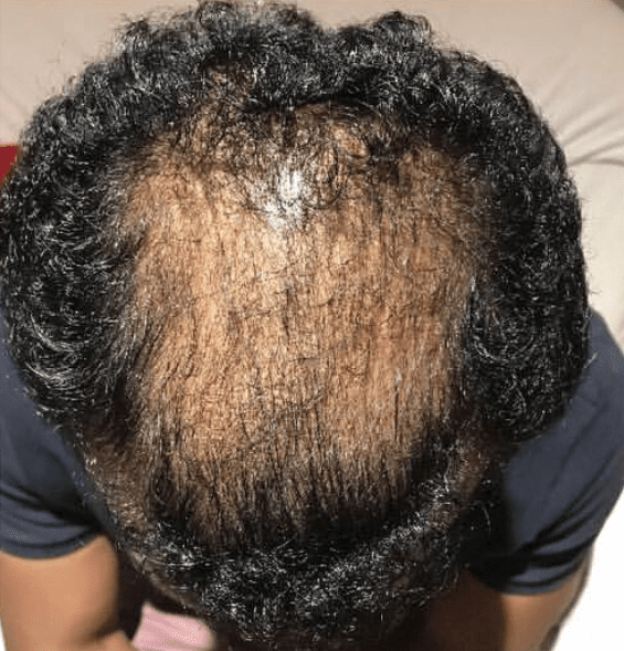 Top view of the head in a man with hair loss in East Brunswick NJ