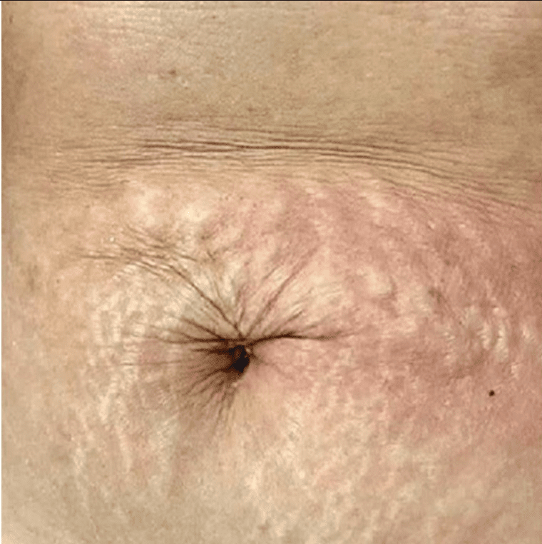 Stretch marks from pregnancy in abdomen before Palomar 1540 or Fraxel lasers