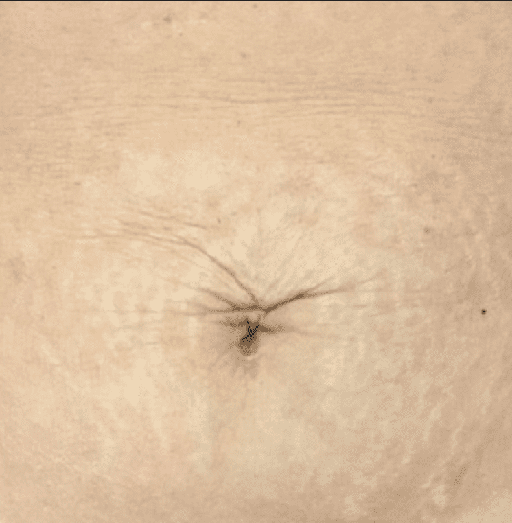 Improved appearance of stretch marks from pregnancy after a series of Palomar 1540 or Fraxel lasers.