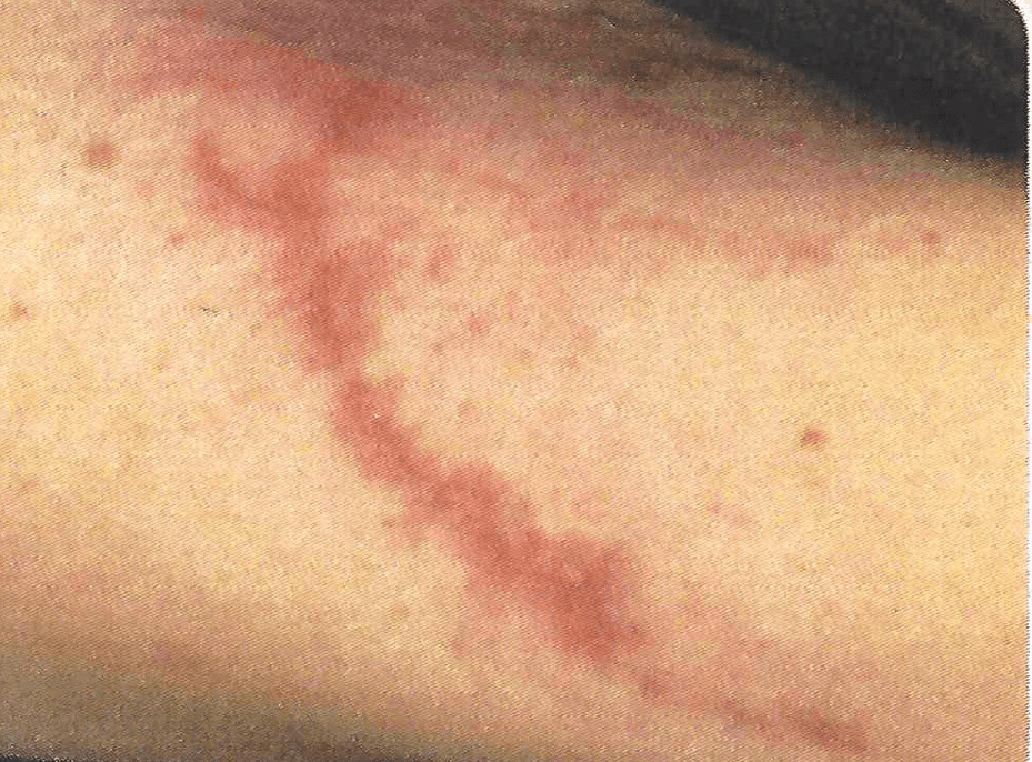 Scar from trauma in leg before Palomar 1540 or Fraxel laser with Max G IPL treatments
