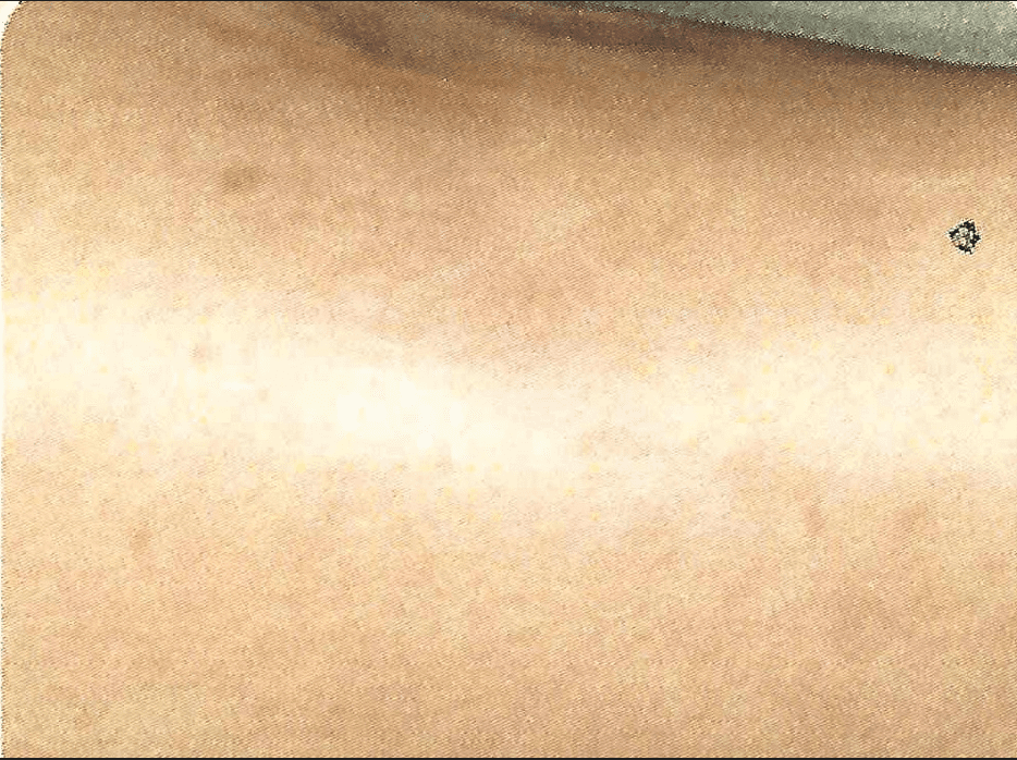 Improved traumatic scar on the leg after Palomar 1540 or Fraxel laser with Max G IPL treatments