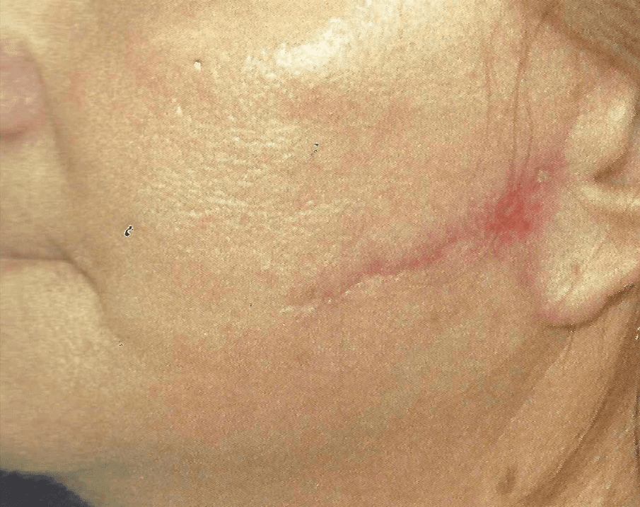 Scar on the cheek from surgery before Palomar 1540 or Fraxel laser treatments