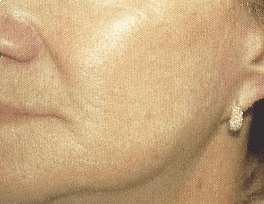 Improved surgical scar on the cheek after Palomar 1540 or Fraxel laser treatments