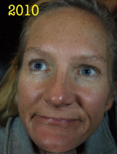 Front view of face showing sun damage, uneven skin tone, volume loss, and aging imperfections