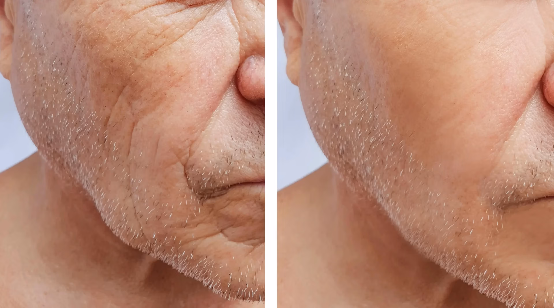 Sculptra treatment (Before-After)