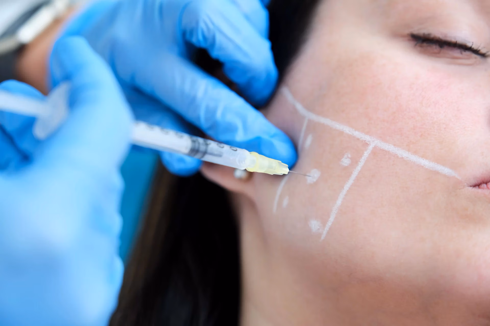 Botox for masseter reduction in East Brunswick, NJ Botox for masseter reduction in East Brunswick NJ