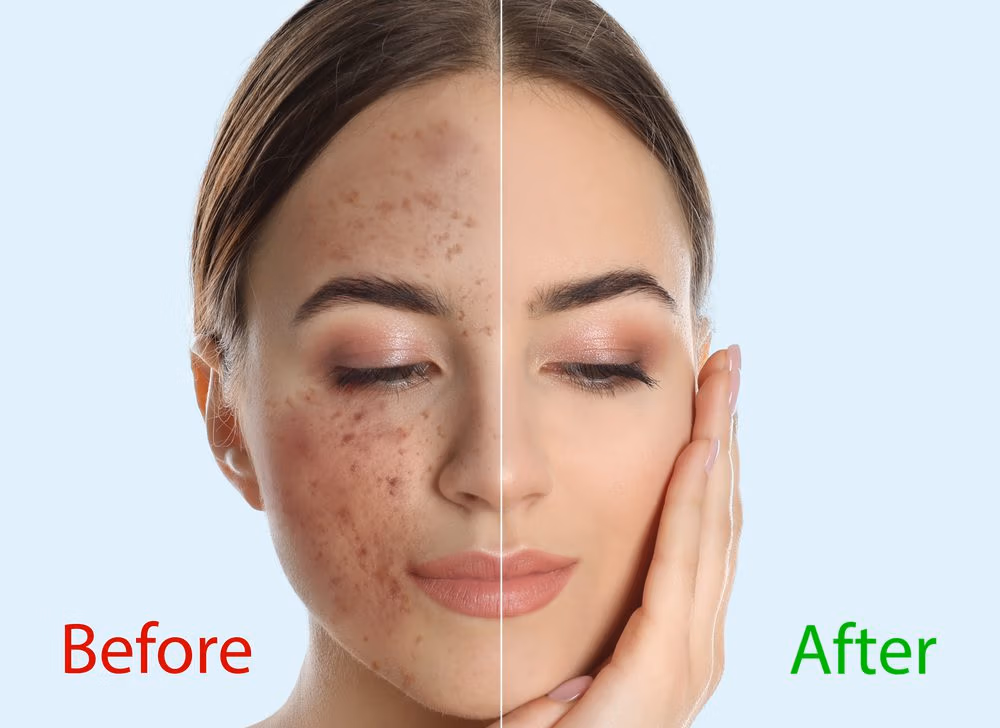 Acne treatment before and after in a woman's face