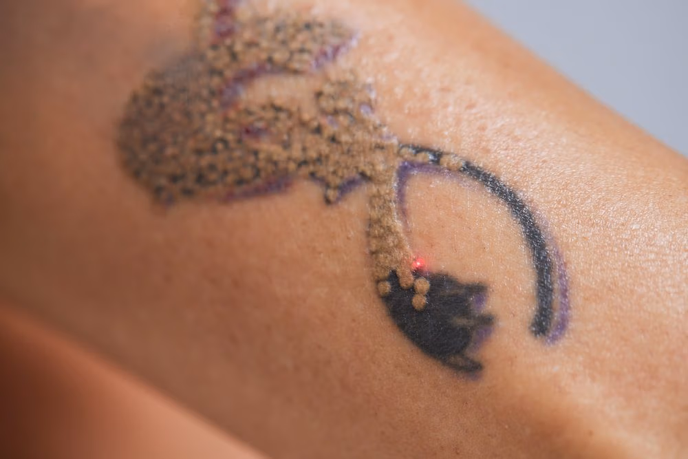 Laser Tattoo Removal at Anara Medspa