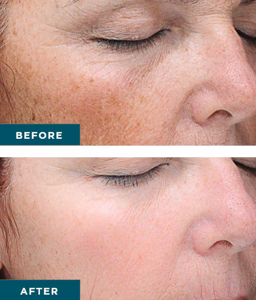 Vi Peel Treatment before and after results Anara Medspa