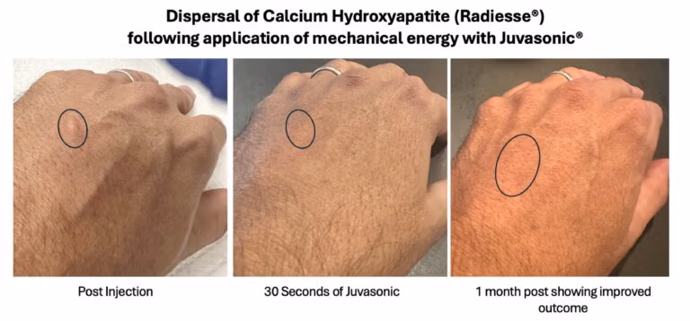 Dispersal of Radiuses with Juvasonic