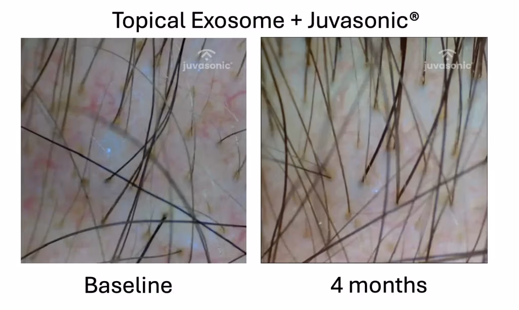 Topical_Exosome_Juvasonic
