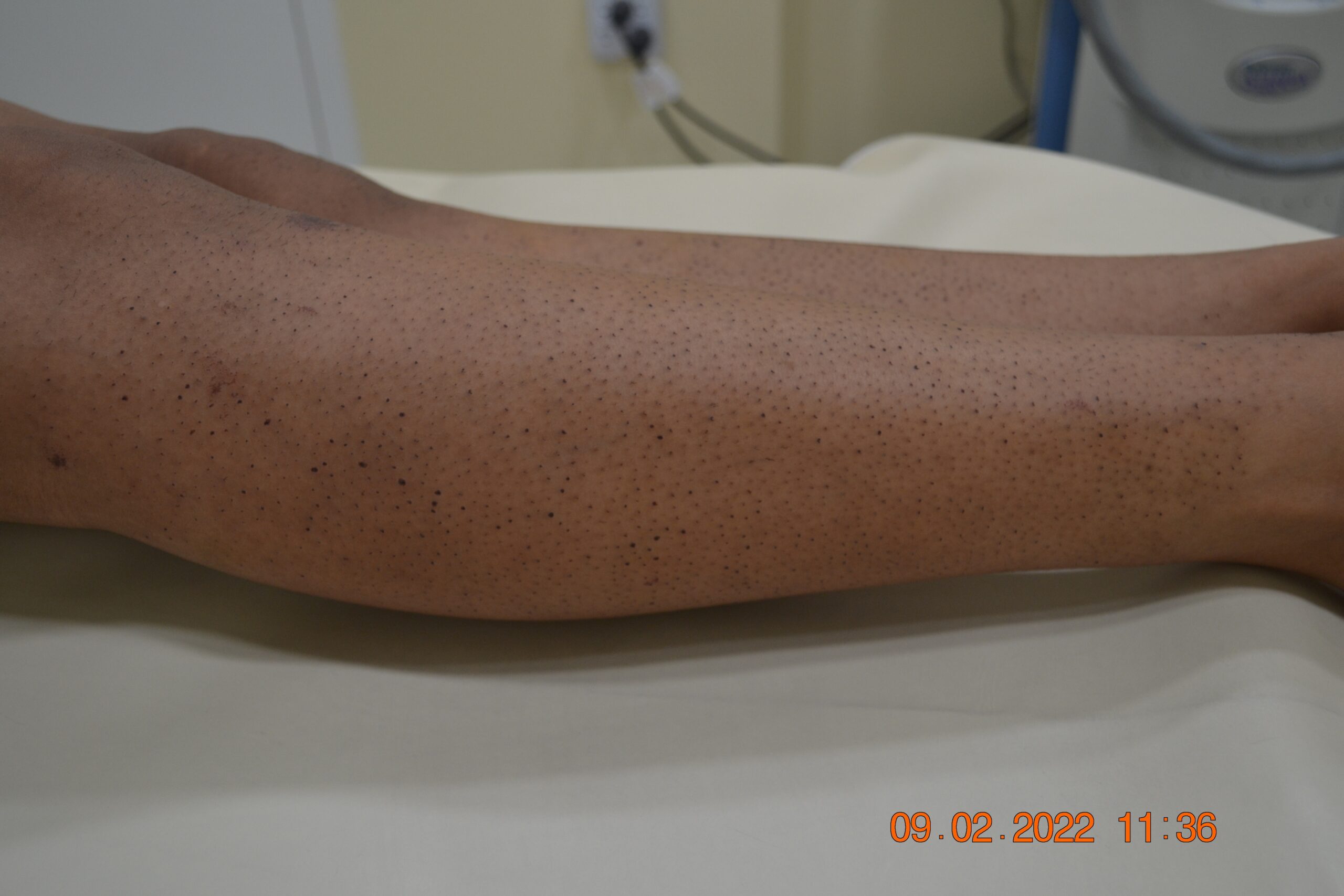 Laser hair Removal
